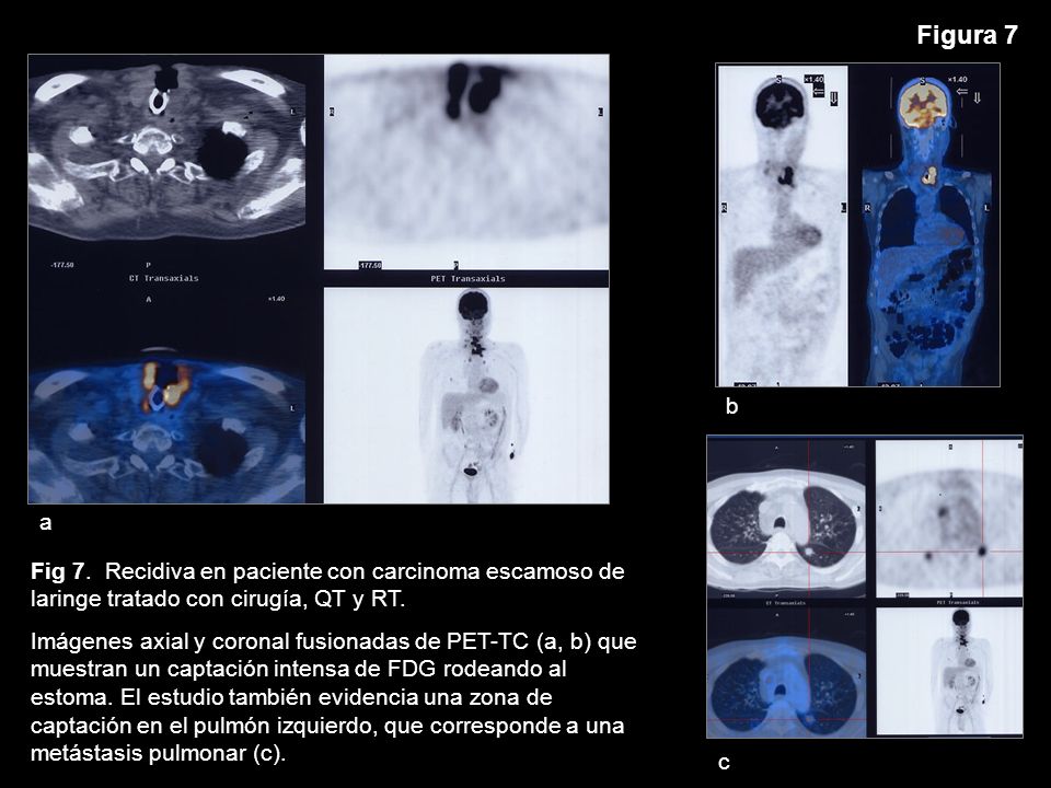 Figura 7 a. b. c. Fig 7. Recidiva en paciente con carcinoma escamoso de laringe tratado con cirugía, QT y RT.