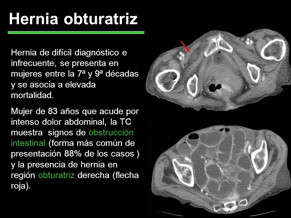 Hernia obturatriz Hernia de difícil diagnóstico e infrecuente, se presenta en mujeres entre la 7ª y 9ª décadas y se asocia a elevada mortalidad.