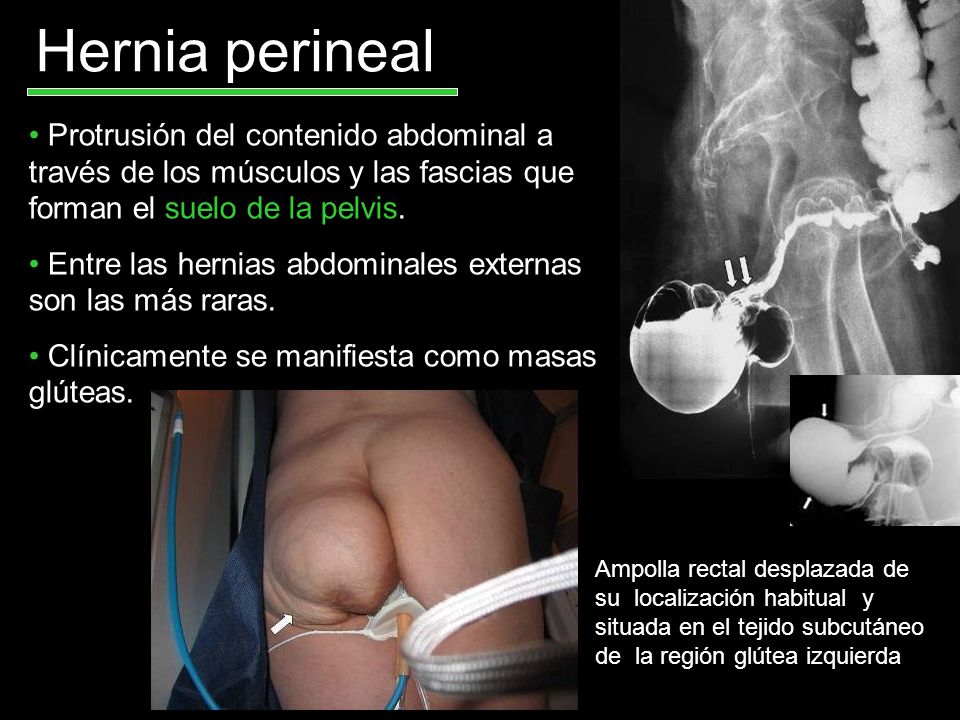 Hernia perineal Protrusión del contenido abdominal a través de los músculos y las fascias que forman el suelo de la pelvis.