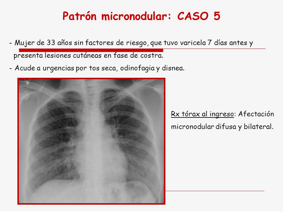 Patrón micronodular: CASO 5