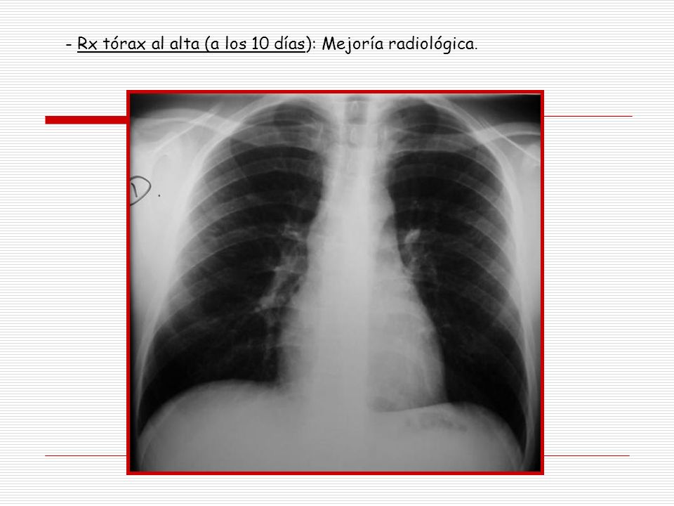 - Rx tórax al alta (a los 10 días): Mejoría radiológica.