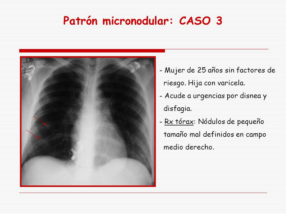 Patrón micronodular: CASO 3