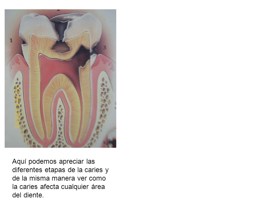 Aquí podemos apreciar las diferentes etapas de la caries y de la misma manera ver como la caries afecta cualquier área del diente.