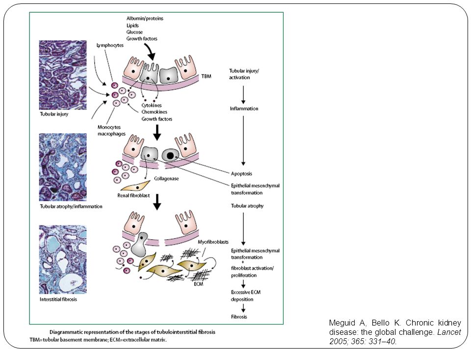 Meguid A, Bello K. Chronic kidney disease: the global challenge