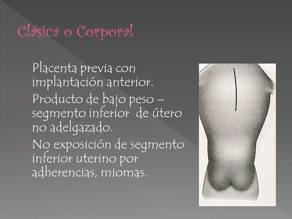 Clásica o Corporal Placenta previa con implantación anterior.