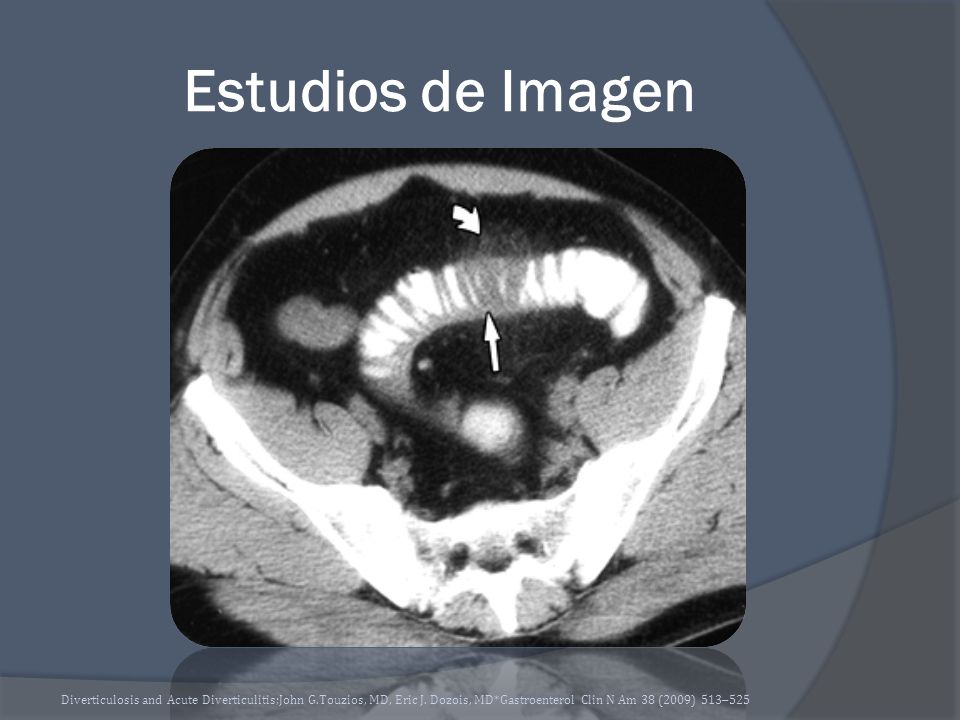 Estudios de Imagen Diverticulosis and Acute Diverticulitis;John G.Touzios, MD, Eric J.