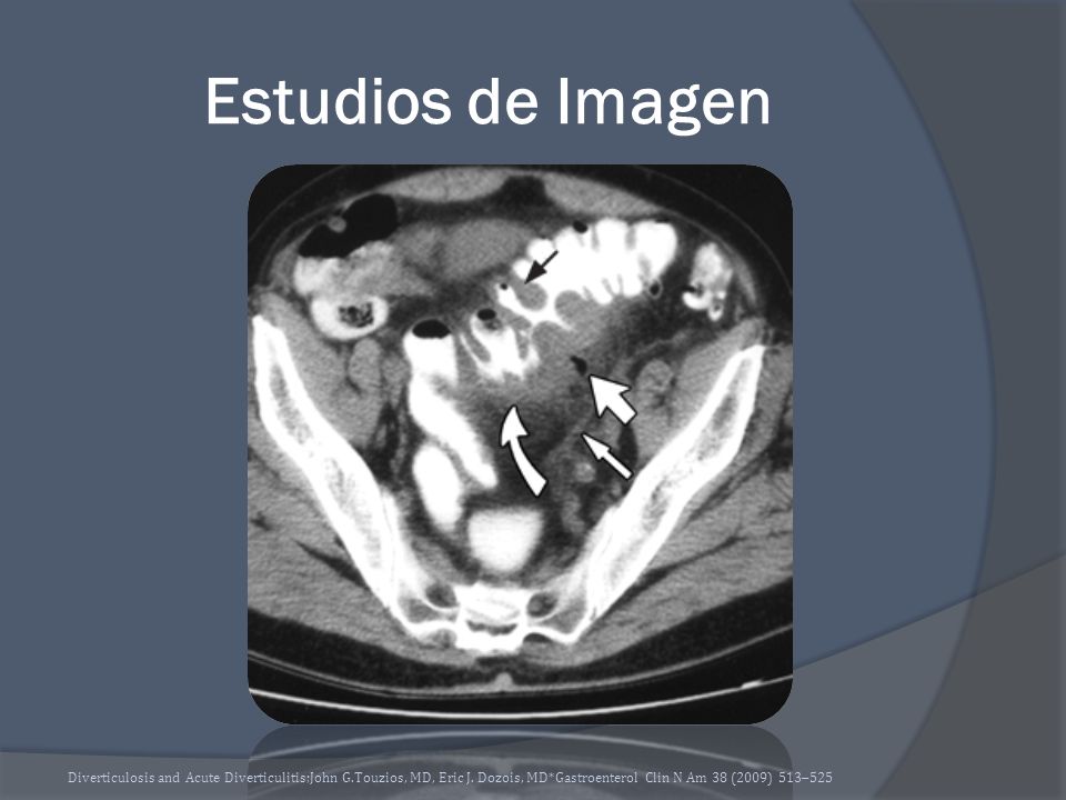 Estudios de Imagen Diverticulosis and Acute Diverticulitis;John G.Touzios, MD, Eric J.