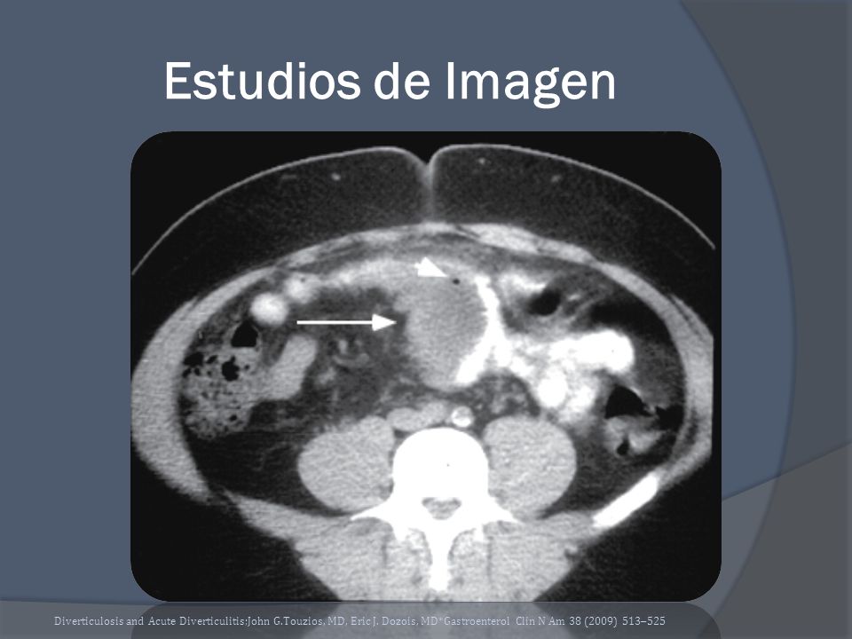 Estudios de Imagen Diverticulosis and Acute Diverticulitis;John G.Touzios, MD, Eric J.