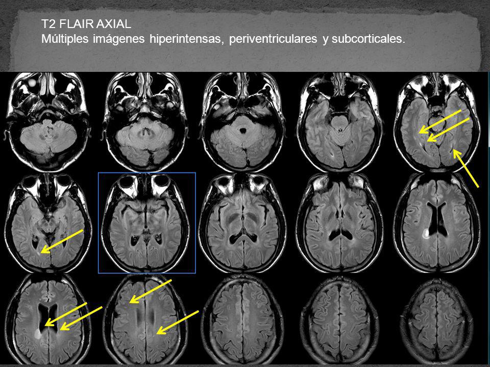 T2 FLAIR AXIAL Múltiples imágenes hiperintensas, periventriculares y subcorticales.