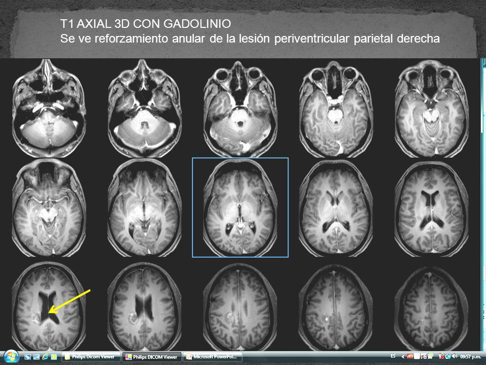T1 AXIAL 3D CON GADOLINIO Se ve reforzamiento anular de la lesión periventricular parietal derecha
