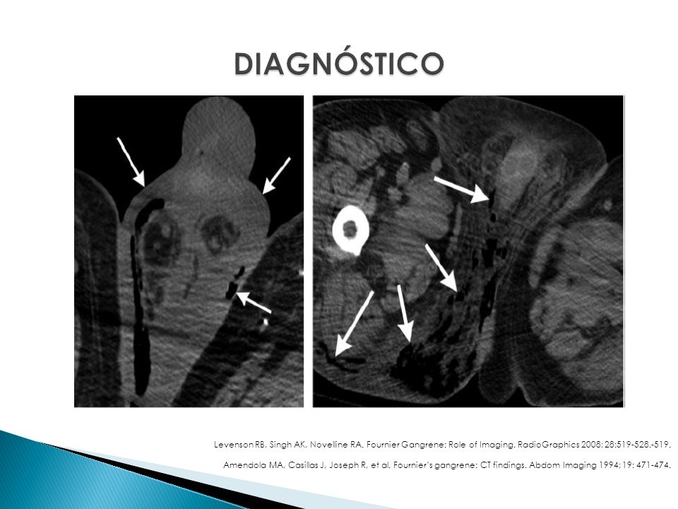 DIAGNÓSTICO Levenson RB, Singh AK, Novelline RA. Fournier Gangrene: Role of Imaging. RadioGraphics 2008; 28: