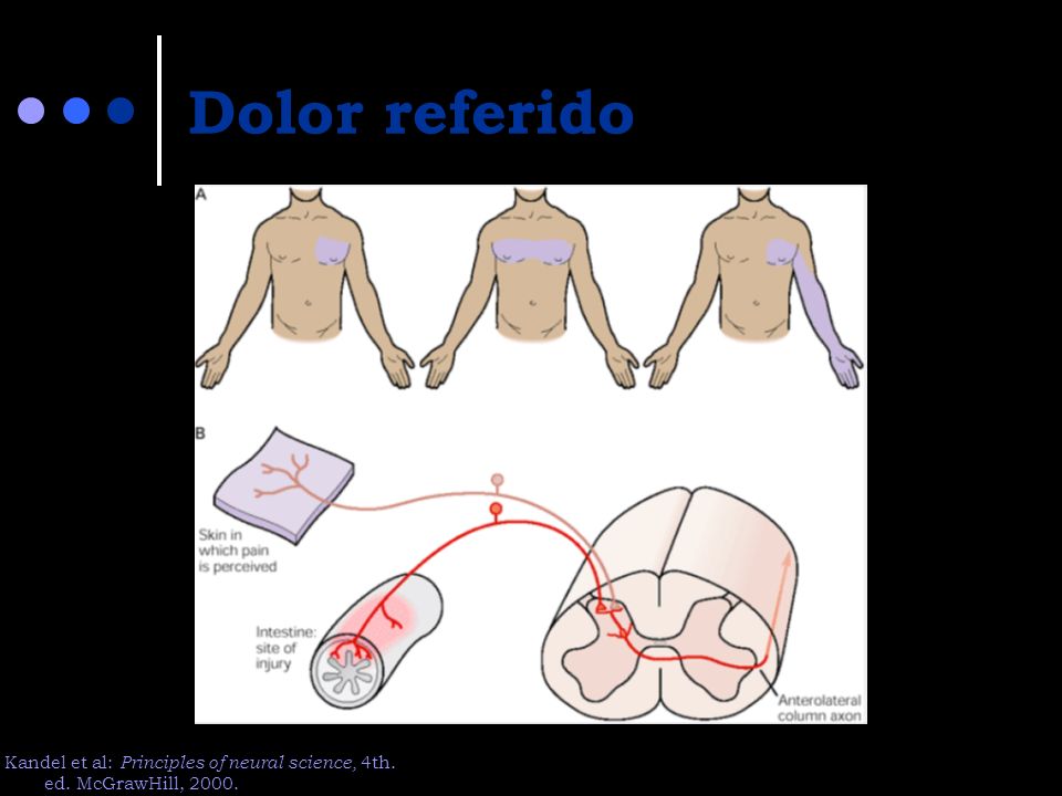 Dolor referido Kandel et al: Principles of neural science, 4th.