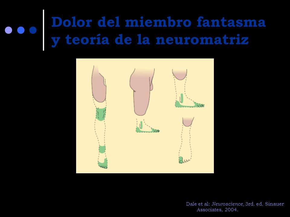 Dolor del miembro fantasma y teoría de la neuromatriz