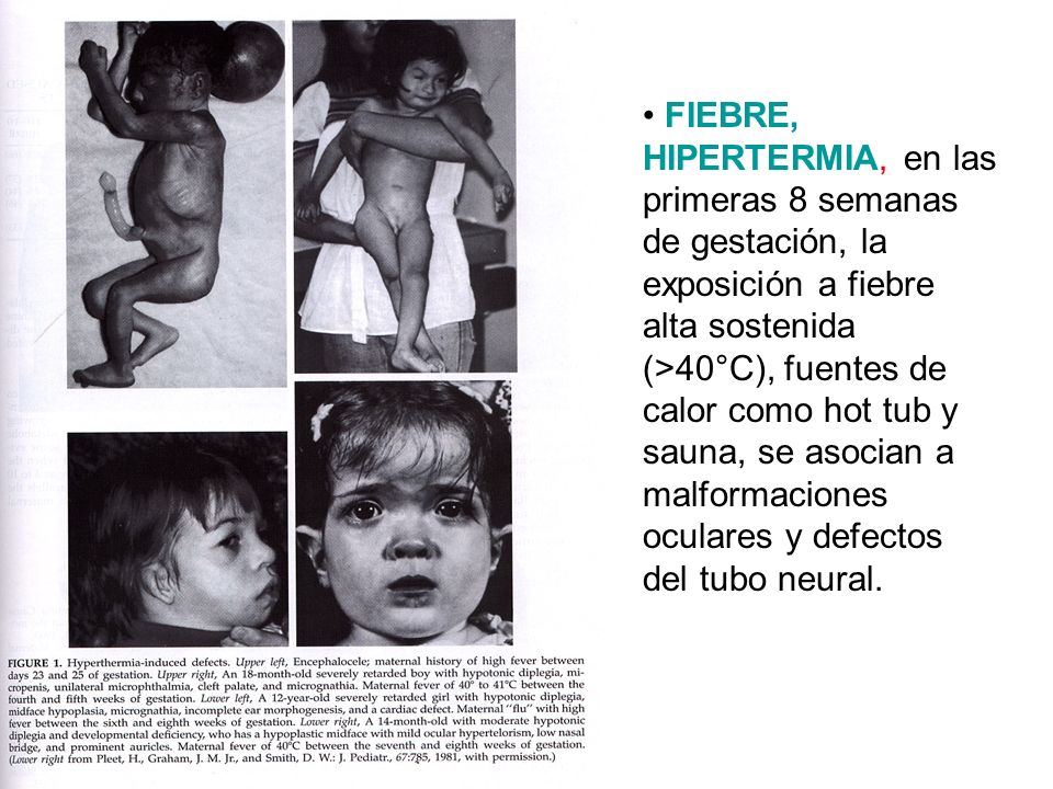 FIEBRE, HIPERTERMIA, en las primeras 8 semanas de gestación, la exposición a fiebre alta sostenida (>40°C), fuentes de calor como hot tub y sauna, se asocian a malformaciones oculares y defectos del tubo neural.