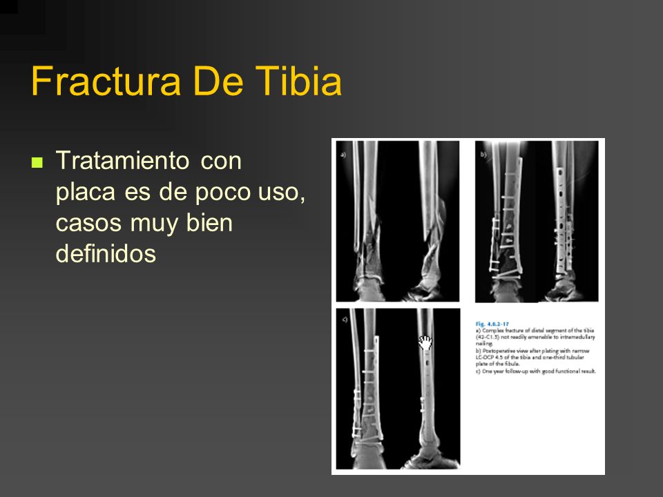 Fractura De Tibia Tratamiento con placa es de poco uso, casos muy bien definidos