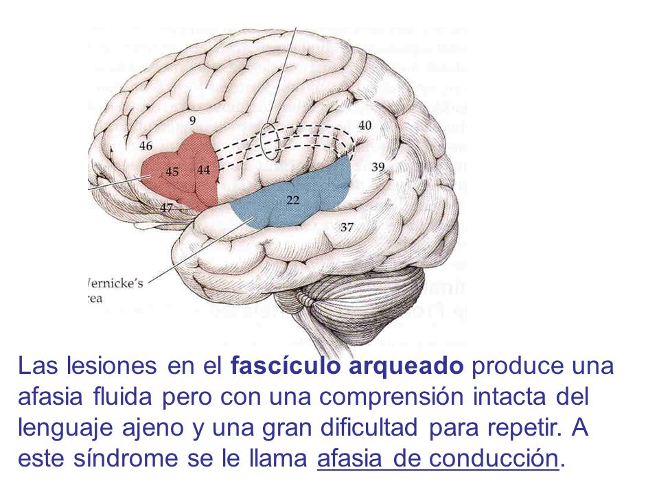 Las lesiones en el fascículo arqueado produce una afasia fluida pero con una comprensión intacta del lenguaje ajeno y una gran dificultad para repetir.