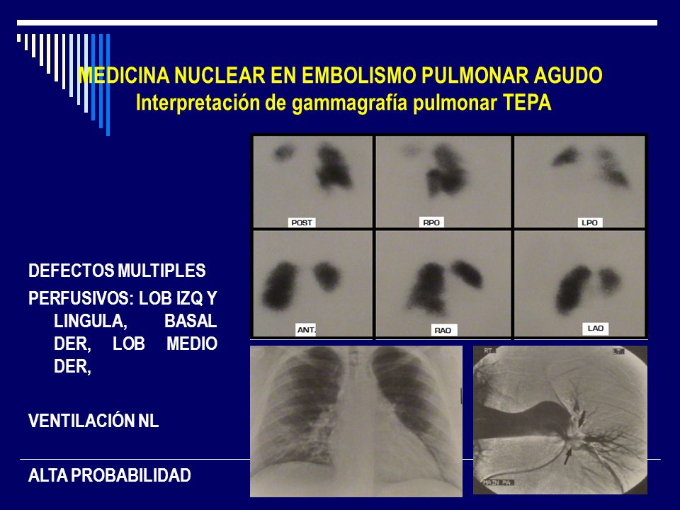 MEDICINA NUCLEAR EN EMBOLISMO PULMONAR AGUDO Interpretación de gammagrafía pulmonar TEPA
