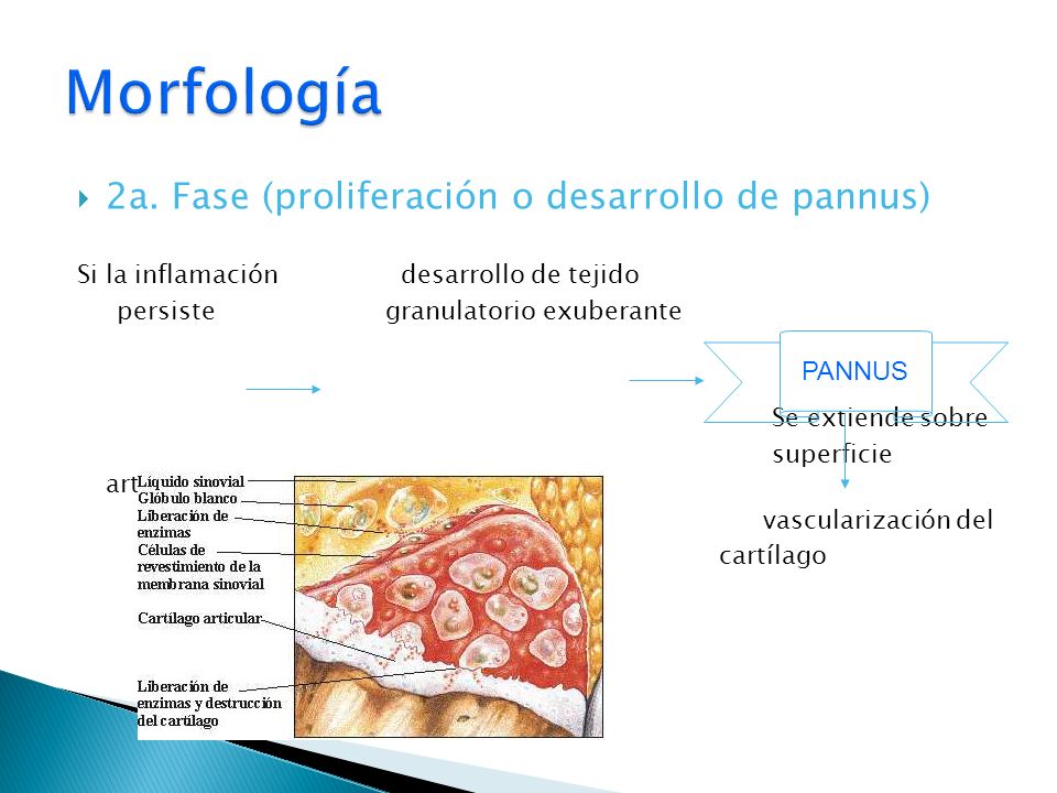 Morfología 2a. Fase (proliferación o desarrollo de pannus) PANNUS