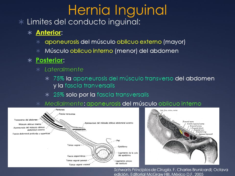 Hernia Inguinal Limites del conducto inguinal: Anterior: Posterior: