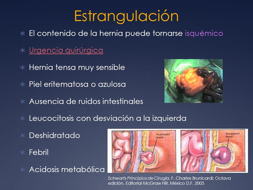 Estrangulación El contenido de la hernia puede tornarse isquémico