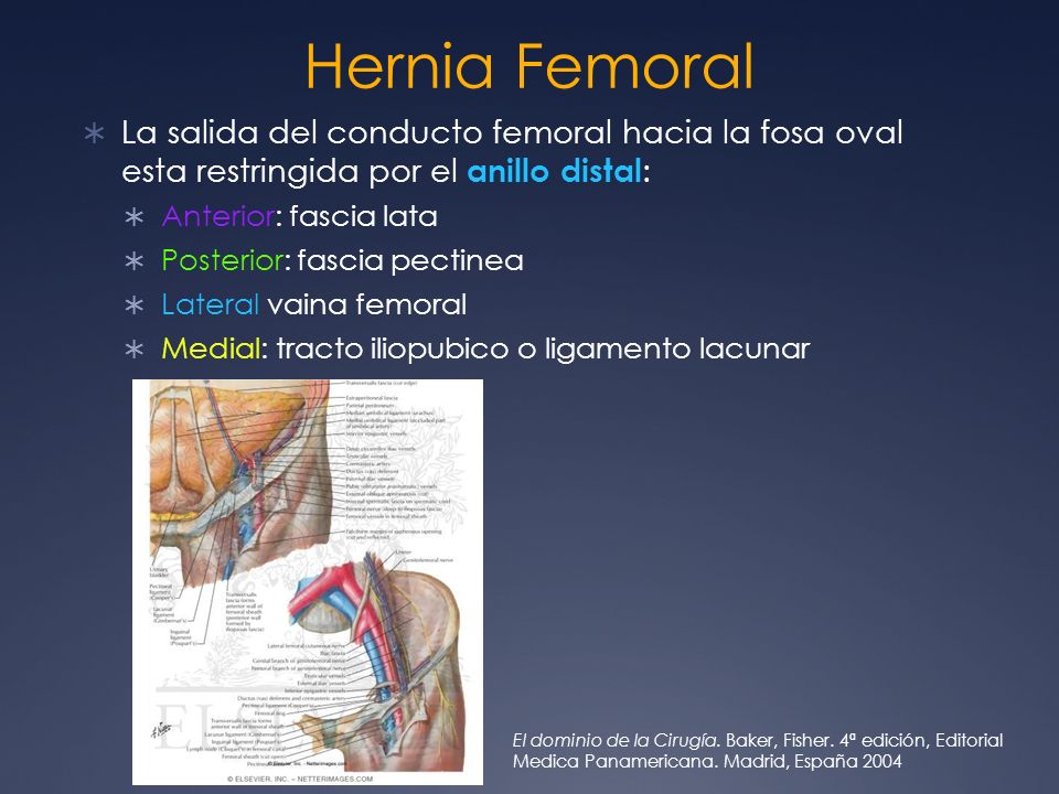 Hernia Femoral La salida del conducto femoral hacia la fosa oval esta restringida por el anillo distal: