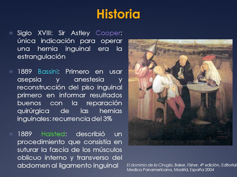 Historia Siglo XVIII: Sir Astley Cooper: única indicación para operar una hernia inguinal era la estrangulación.