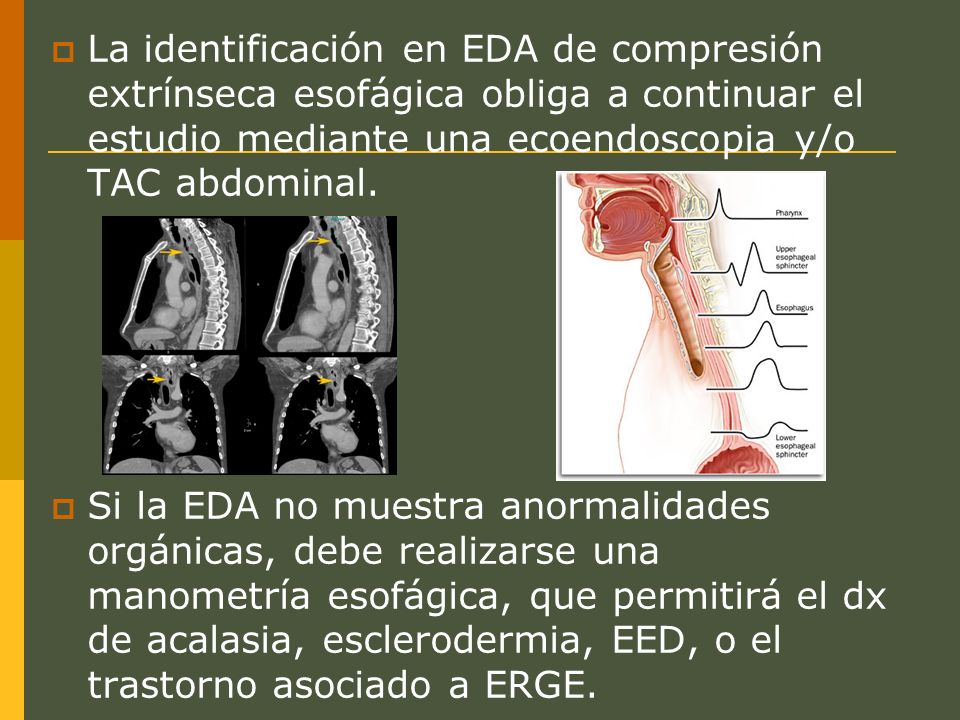 La identificación en EDA de compresión extrínseca esofágica obliga a continuar el estudio mediante una ecoendoscopia y/o TAC abdominal.