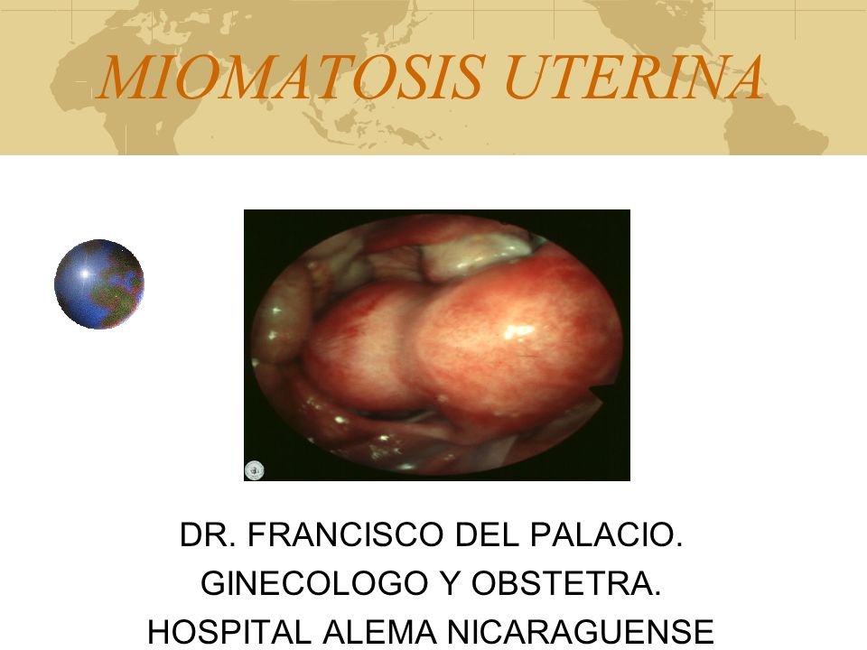MIOMATOSIS UTERINA DR. FRANCISCO DEL PALACIO. GINECOLOGO Y OBSTETRA.