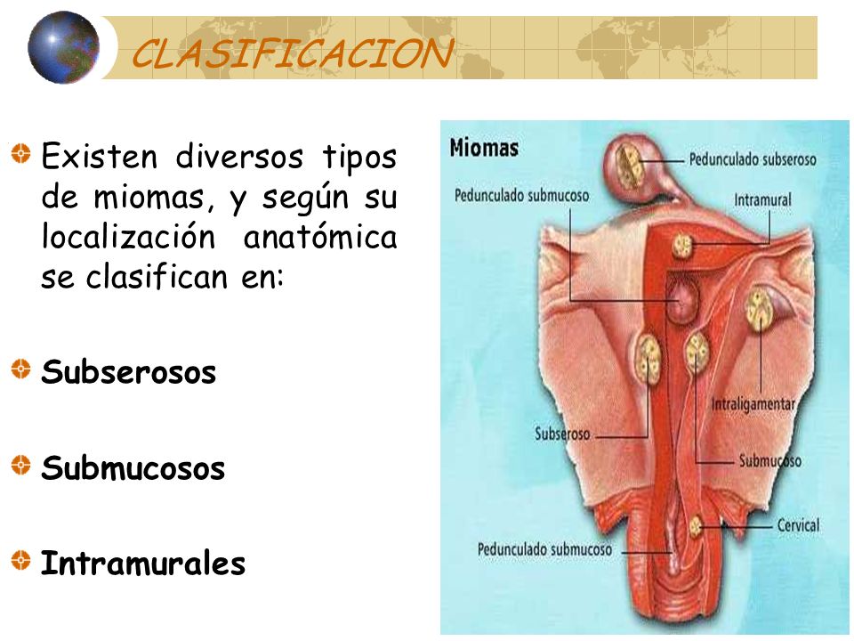 CLASIFICACION Existen diversos tipos de miomas, y según su localización anatómica se clasifican en: