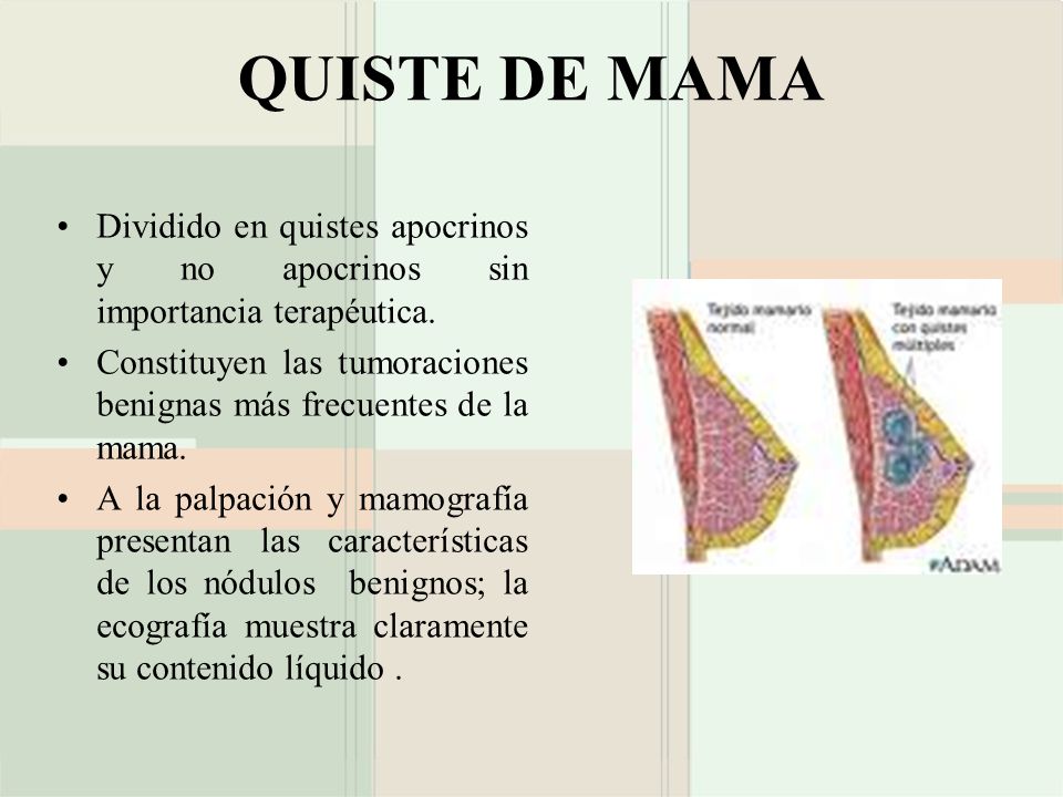 QUISTE DE MAMA Dividido en quistes apocrinos y no apocrinos sin importancia terapéutica.