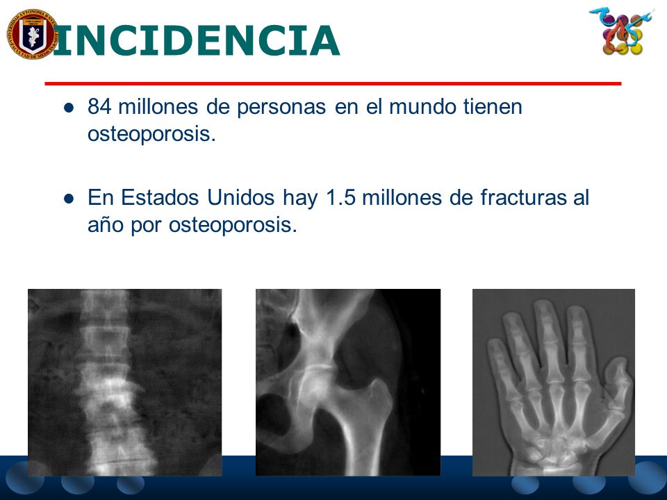 INCIDENCIA 84 millones de personas en el mundo tienen osteoporosis.