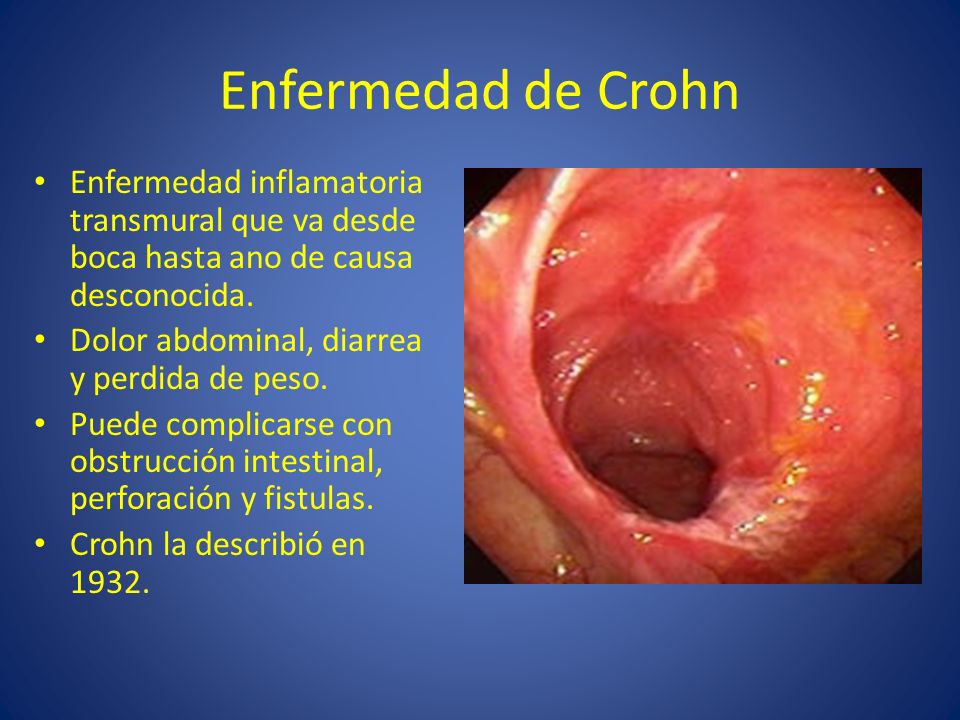 Enfermedad de Crohn Enfermedad inflamatoria transmural que va desde boca hasta ano de causa desconocida.