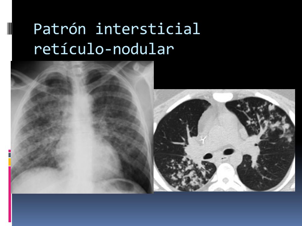 Patrón intersticial retículo-nodular