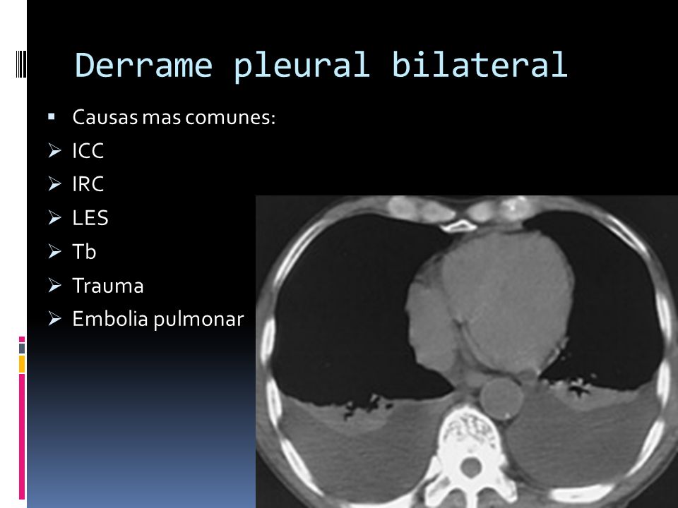 Derrame pleural bilateral