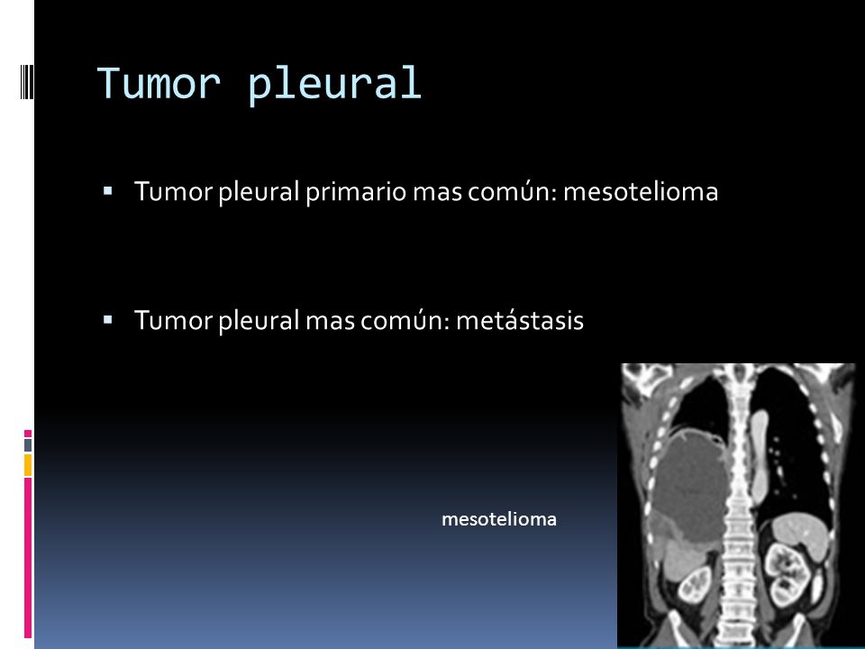 Tumor pleural Tumor pleural primario mas común: mesotelioma