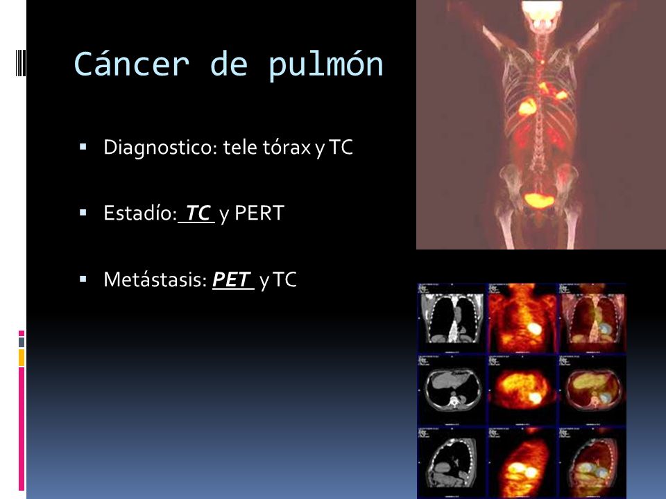 Cáncer de pulmón Diagnostico: tele tórax y TC Estadío: TC y PERT