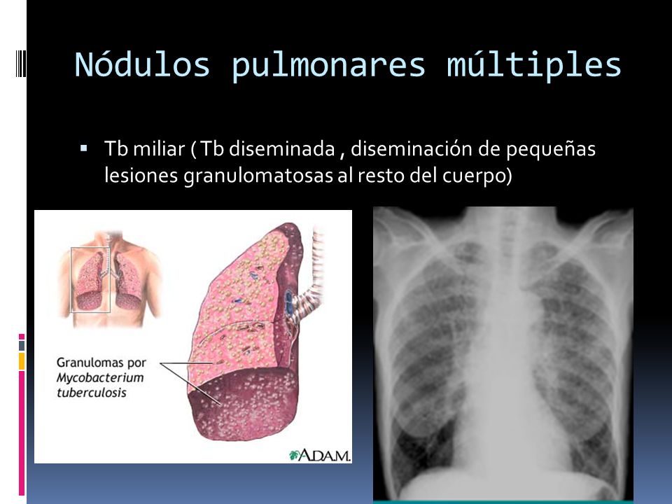 Nódulos pulmonares múltiples