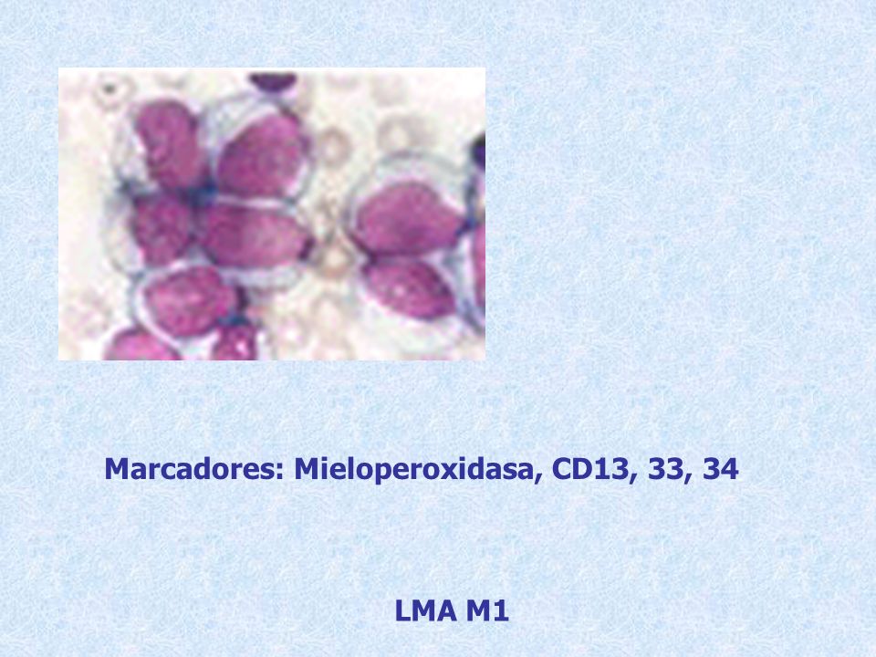 Marcadores: Mieloperoxidasa, CD13, 33, 34