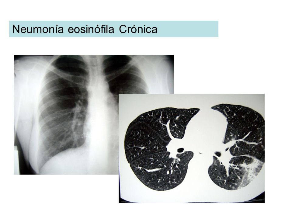 Neumonía eosinófila Crónica