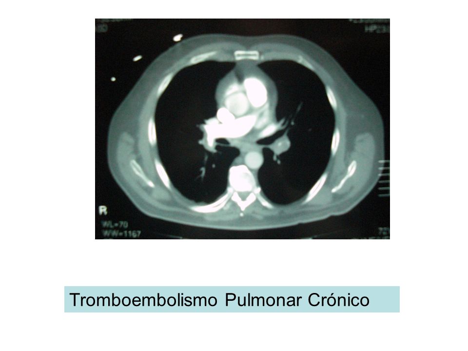 Tromboembolismo Pulmonar Crónico