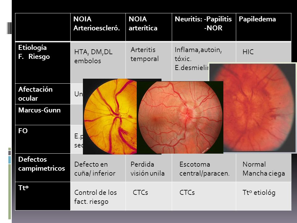 NOIA Arterioescleró. arterítica. Neuritis: -Papilitis. -NOR. Papiledema. Etiología. F. Riesgo.