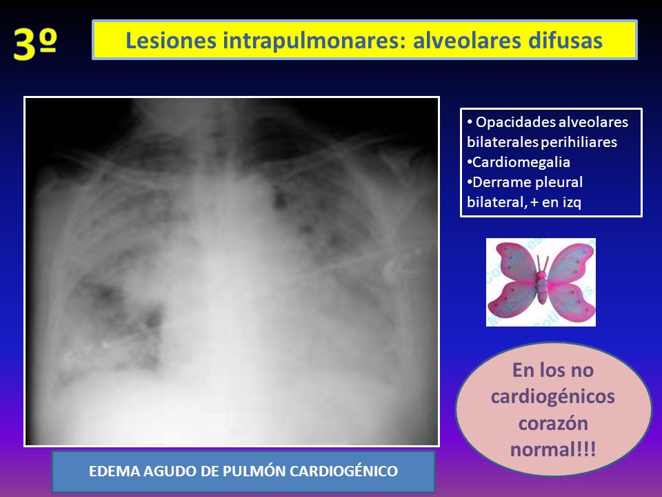 3º Lesiones intrapulmonares: alveolares difusas