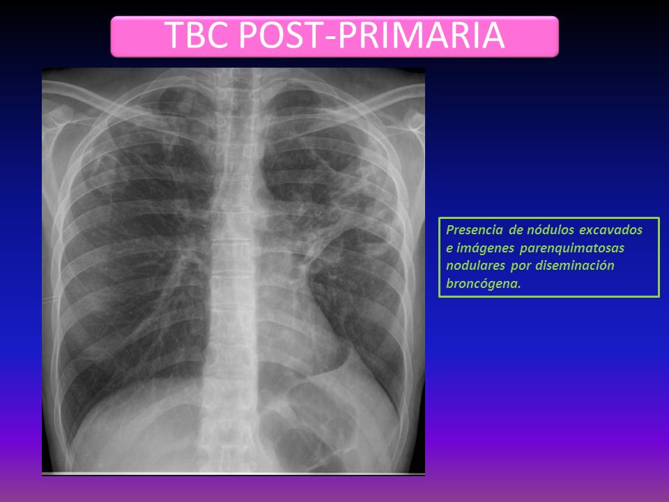 TBC POST-PRIMARIA Presencia de nódulos excavados e imágenes parenquimatosas nodulares por diseminación broncógena.