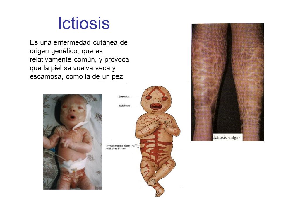 Ictiosis Es una enfermedad cutánea de origen genético, que es relativamente común, y provoca que la piel se vuelva seca y escamosa, como la de un pez.