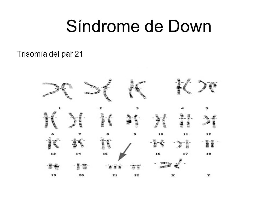 Síndrome de Down Trisomía del par 21