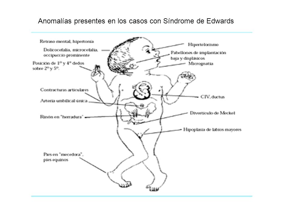 Anomalías presentes en los casos con Síndrome de Edwards