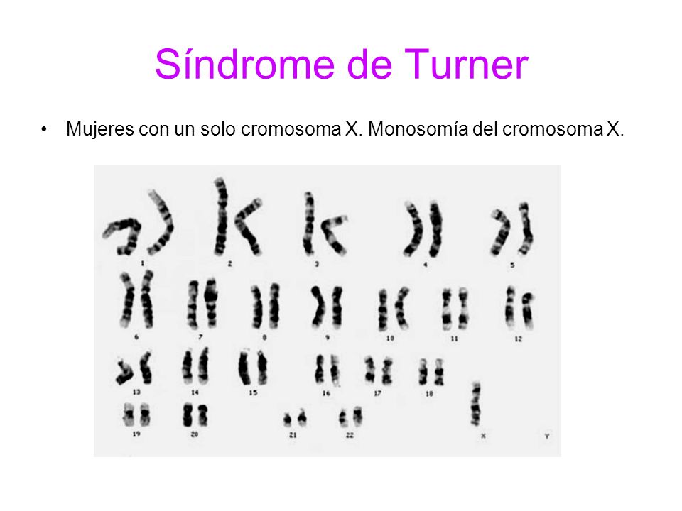 Mujeres con un solo cromosoma X. Monosomía del cromosoma X.