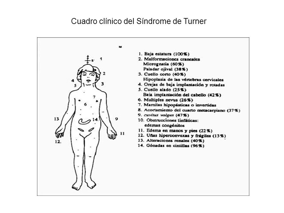 Cuadro clínico del Síndrome de Turner