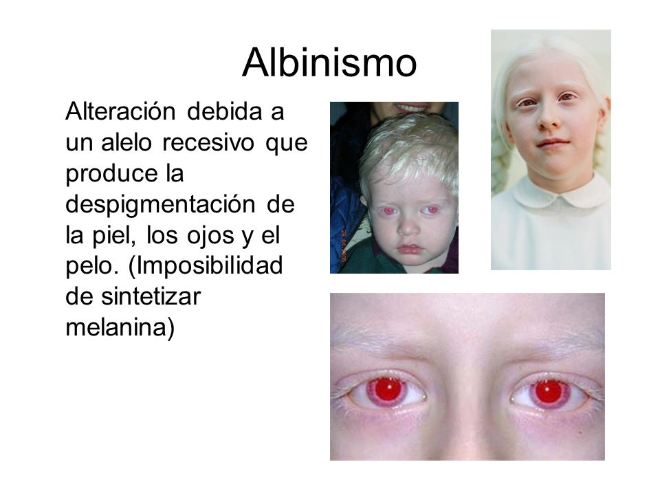 Albinismo Alteración debida a un alelo recesivo que produce la despigmentación de la piel, los ojos y el pelo.