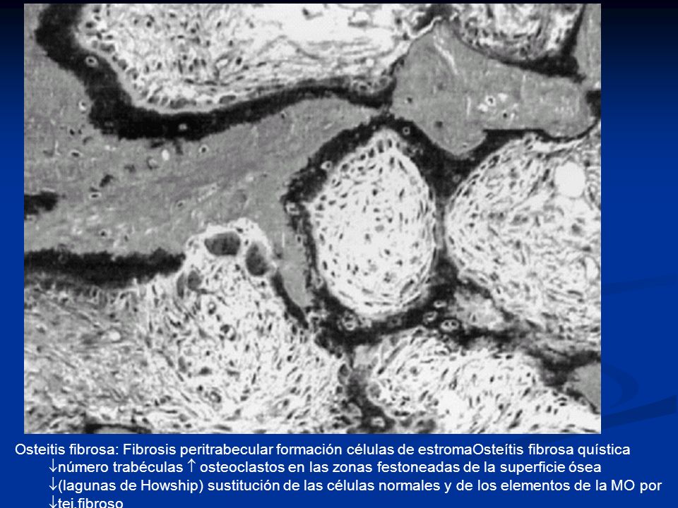 Osteitis fibrosa: Fibrosis peritrabecular formación células de estromaOsteítis fibrosa quística